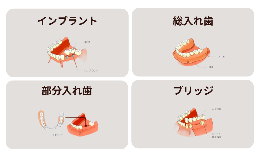 インプラント・総入れ歯・部分入れ歯・ブリッジの違い