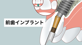 前歯インプラント