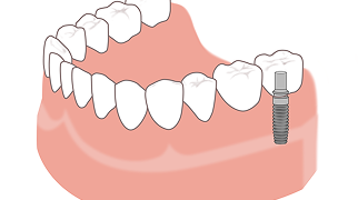 奥歯インプラント