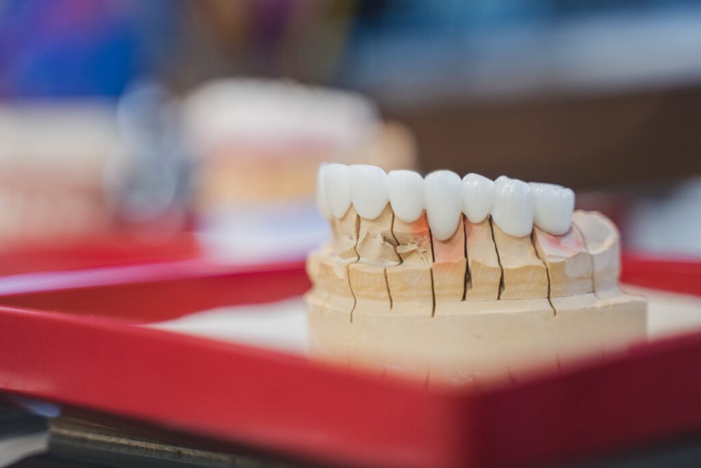 インプラントの模型