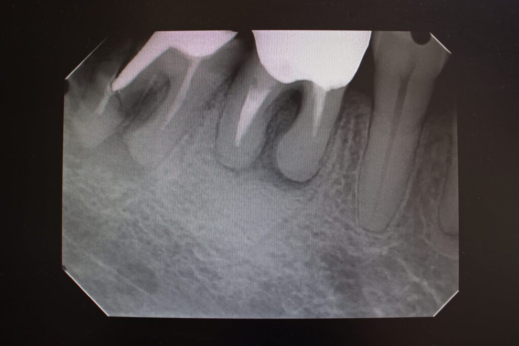 歯根が写ったレントゲン写真